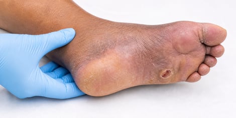 Early Warning Signs of Diabetic Foot Problems: Symptoms You Should Never Ignore