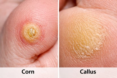 Corn vs Callus: How to Tell Them Apart and Why It Matters for Treatment