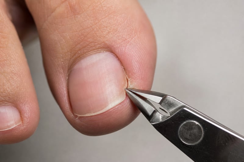 Ingrown Toenail Close Up with Clippers