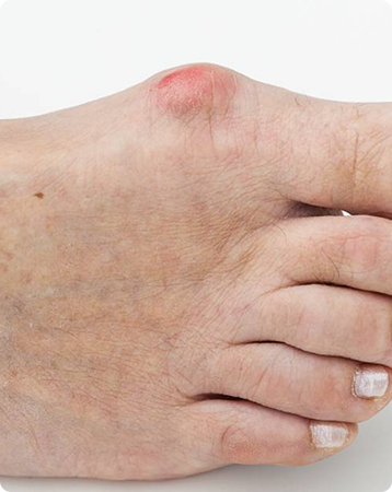 Bunion-Inflammation