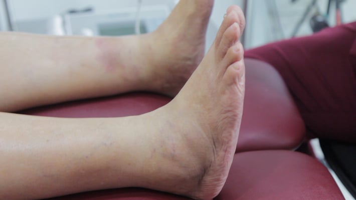 charcot