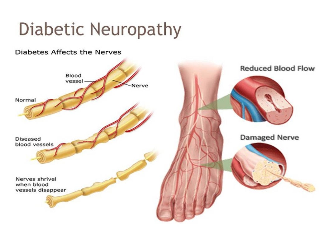 diabetic-neuropathy-how-it-look-like