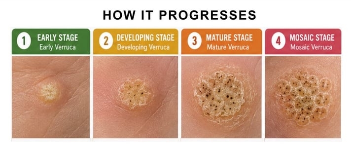 HOW IT PROGRESSES - Plantar Warts