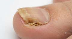 Distal Subungual Onychomycosis