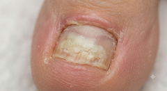 Proximal Subungual Onychomycosis