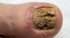 Total Dystrophic Onychomycosis