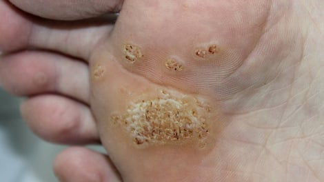 Plantar Warts 101: A Comprehensive Guide to Plantar Wart Infection, Diagnosis and Treatment