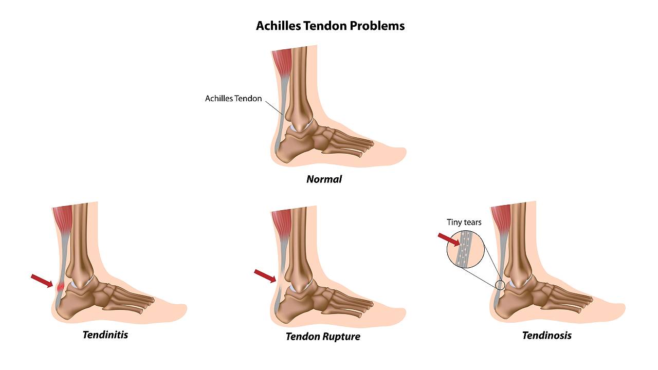Achilles-Tendon-Problems