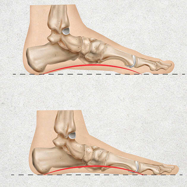 Acquired_ Can occur to all arch types at any age