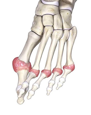 Arthritis