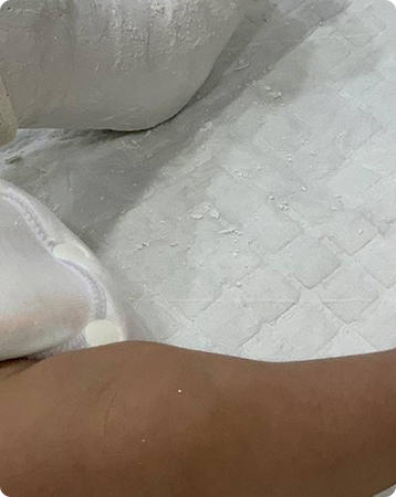 Bow legs in children – what are bow legs & how can it be managed