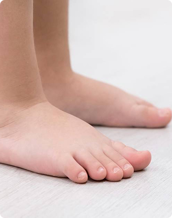 Paediatric Flat Feet – Flat Feet in Children