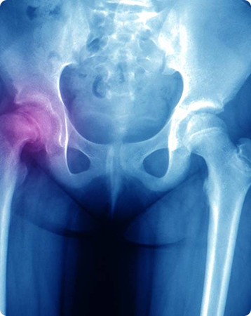 Paediatric Hip Pain