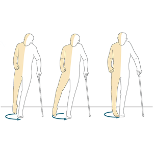 Circumduction-gait-pattern-1