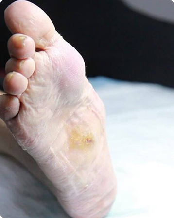 Charcot Foot Causes, Symptoms, and Management