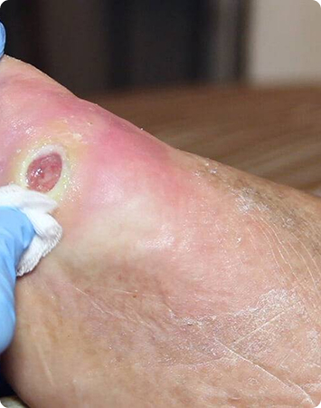 Diabetic Foot Ulcer and Wound