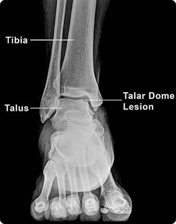 Talar-Dome-Injuries
