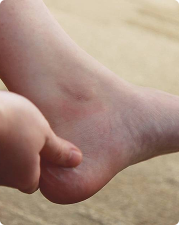 Tarsal-Tunnel-Syndrome