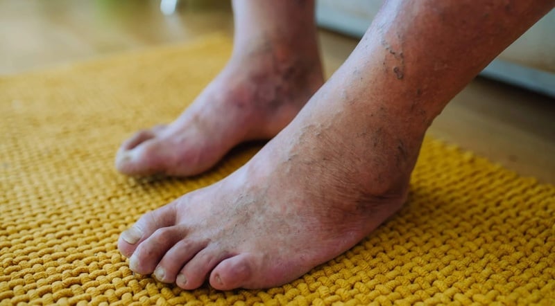 heel pain - age related and diabetes