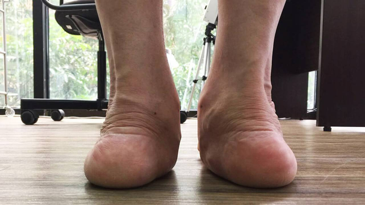 Kinds-Of-Flat-Feet-1