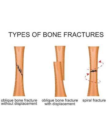 Fractures