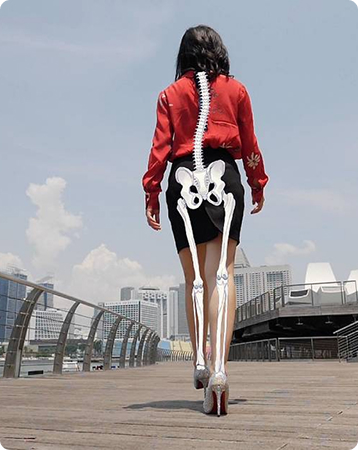 Malalignment syndrome