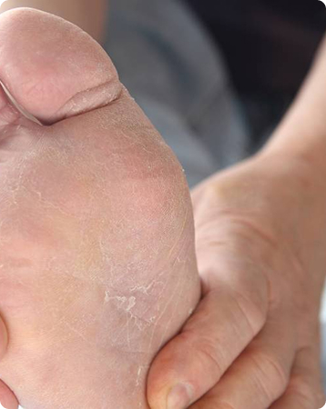 Athletes Foot Causes, Symptoms, and Management