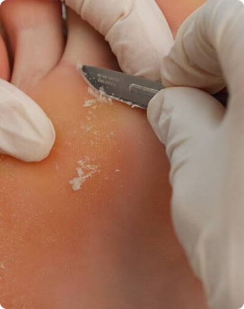 Foot Callus Causes, Symptoms, and Removal