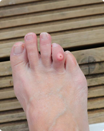 Foot Corn Causes, Symptoms, and Removal