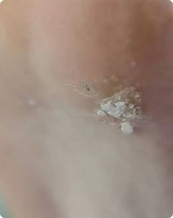 Plantar Wart Causes, Symptoms, and Removal