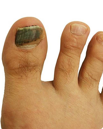Toenail Trauma Causes, Symptoms, and Prevention