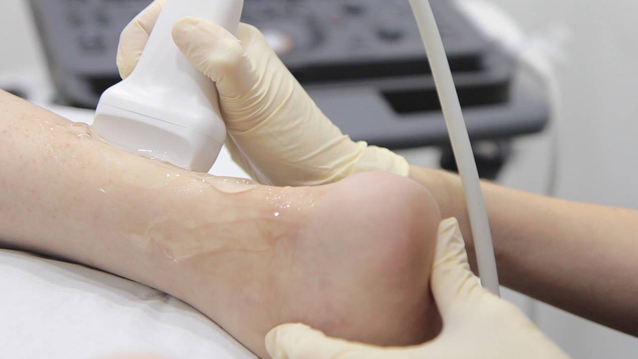 achilles-tendonitis-treatment