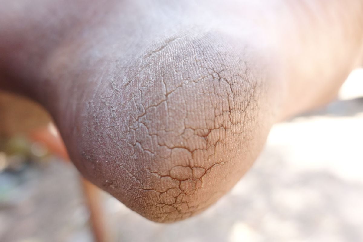 East Coast Podiatry Blog - Cracked Heels