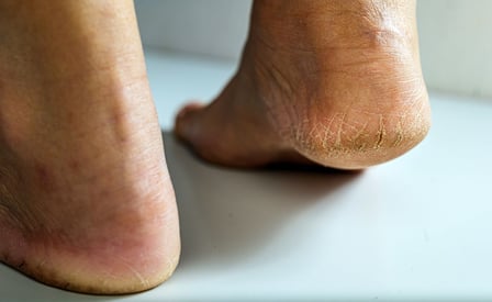What Causes Cracked Heels? Causes, Treatments, and Prevention