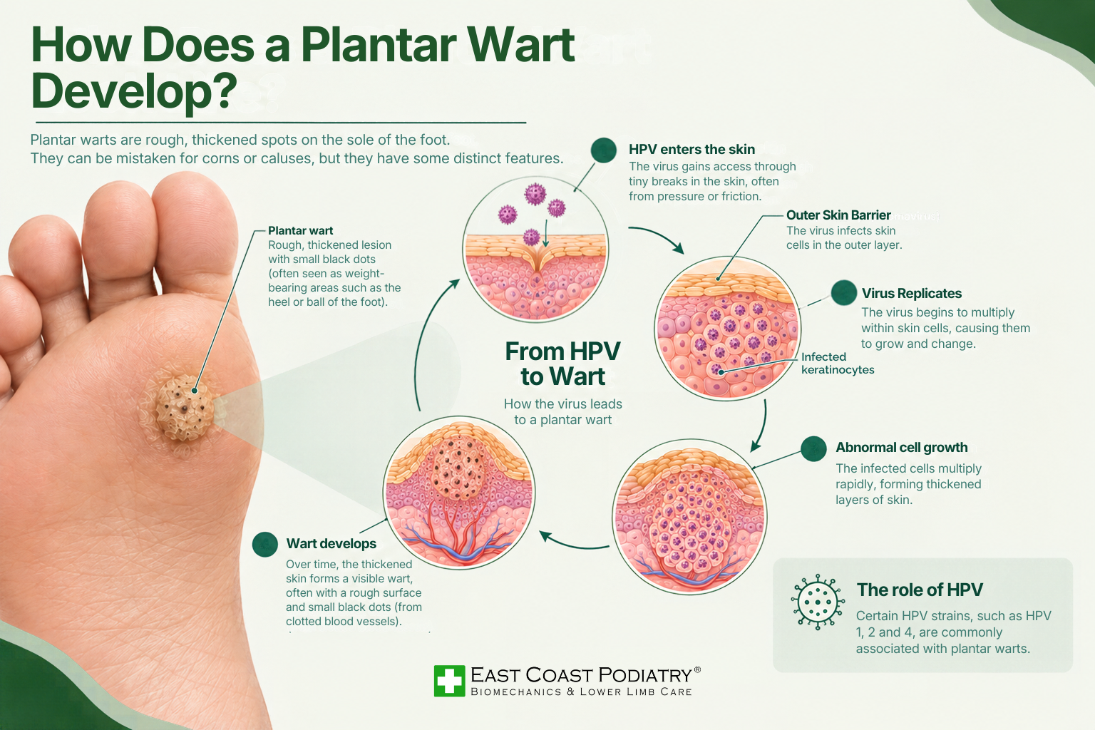 How Does a Plantar Wart Develop