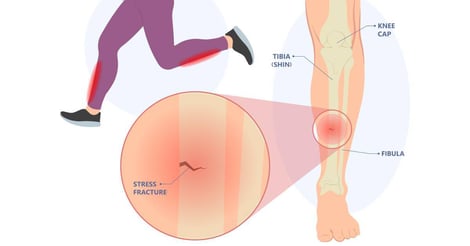 All You Need to Know About Stress Fractures
