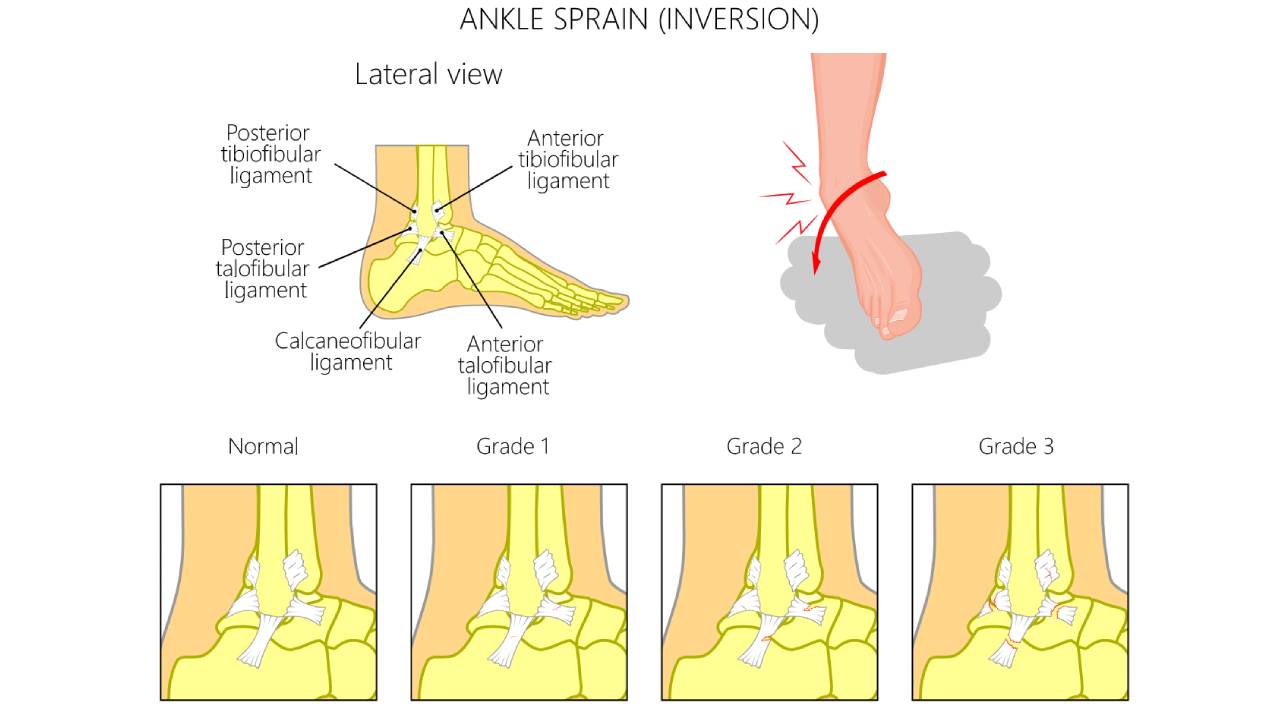 ankle-sprain-inversion-diagram