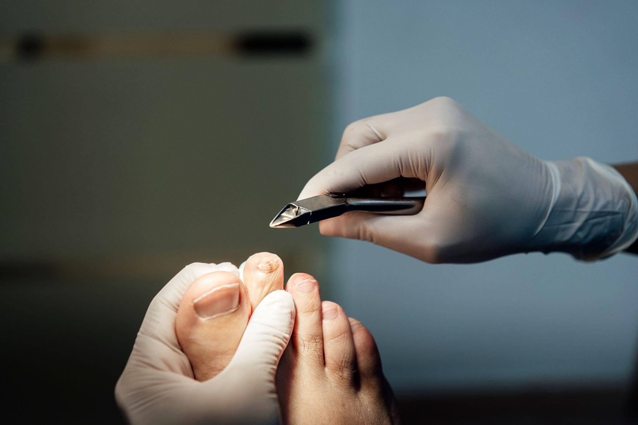 Fungal Toenail vs Paronychia: Know the Key Differences