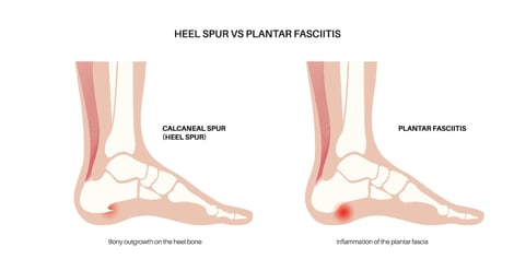 Heel Spur vs Plantar Fasciitis: Why Heel Hurts After Running