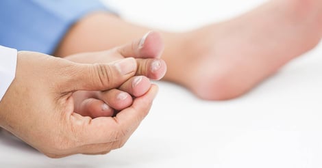 Ingrown Toenails Explained