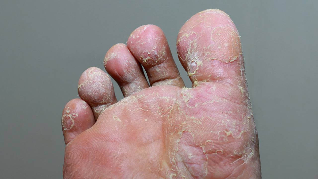 nsfnsmen-with-foot-problems-image-5