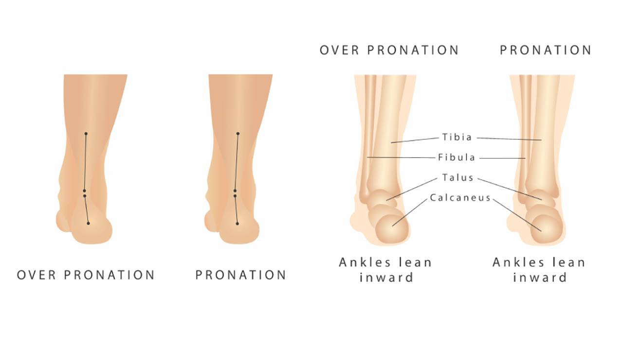 overpronation