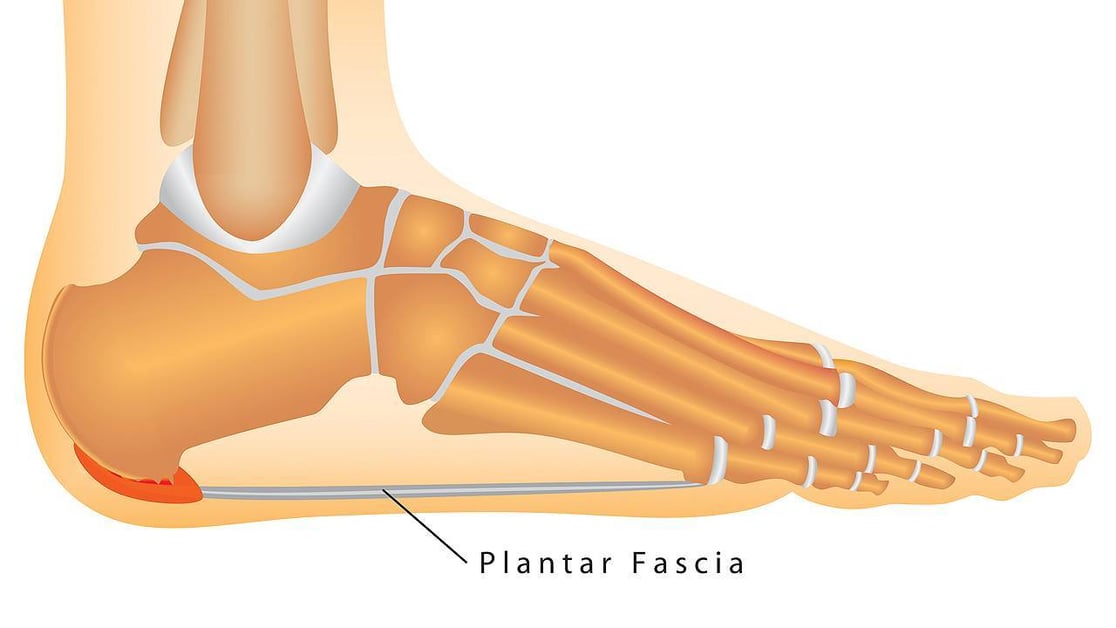 plantar-fascia-tear-image-1