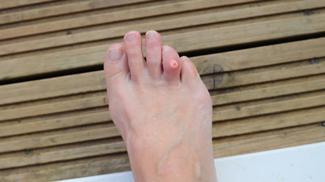 Will Foot Corns Ever Go Away on Their Own?