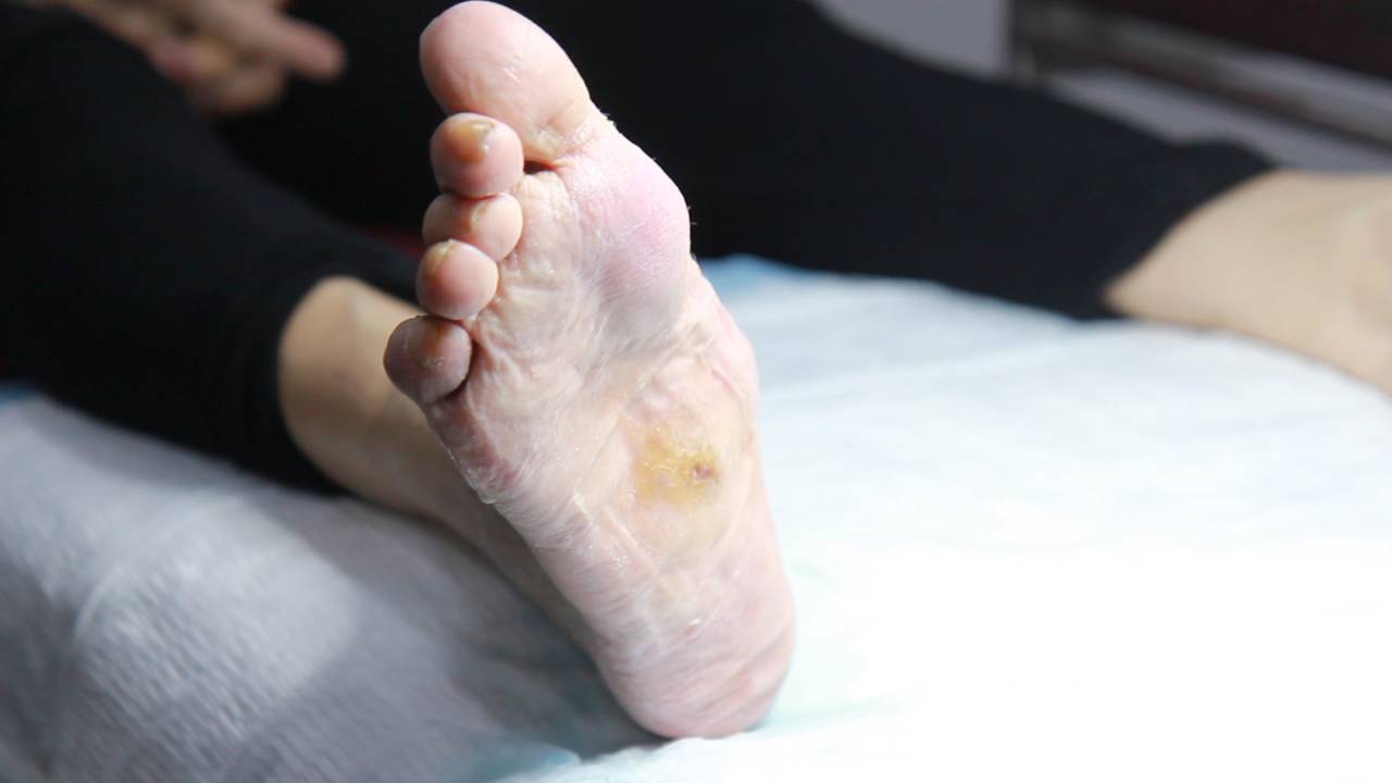 charcot-foot-ulcer