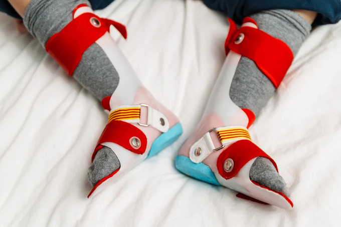 congenital flat foot addressed