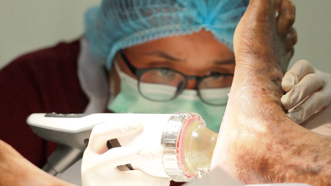 defocused-shockwave-therapy-image-1