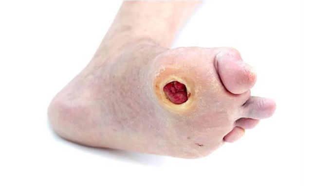 diabetic-foot-conditions-image