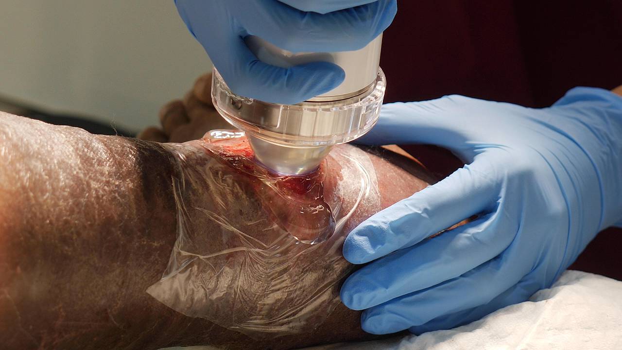 diabetic-foot-ulcer-wound-image-2