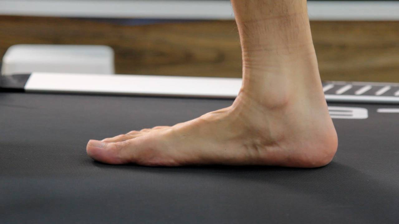 flat-feet-biomechanical-assessment